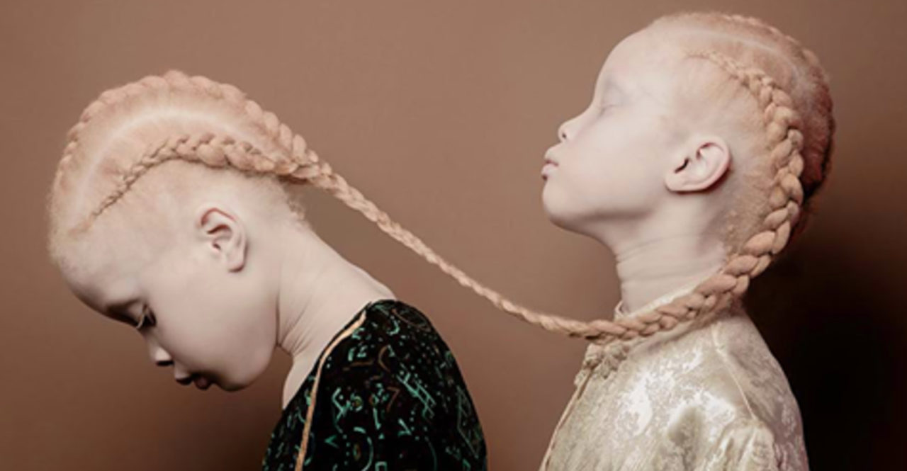 CEDAR-COM_ALBINISM_Featured_Image.png